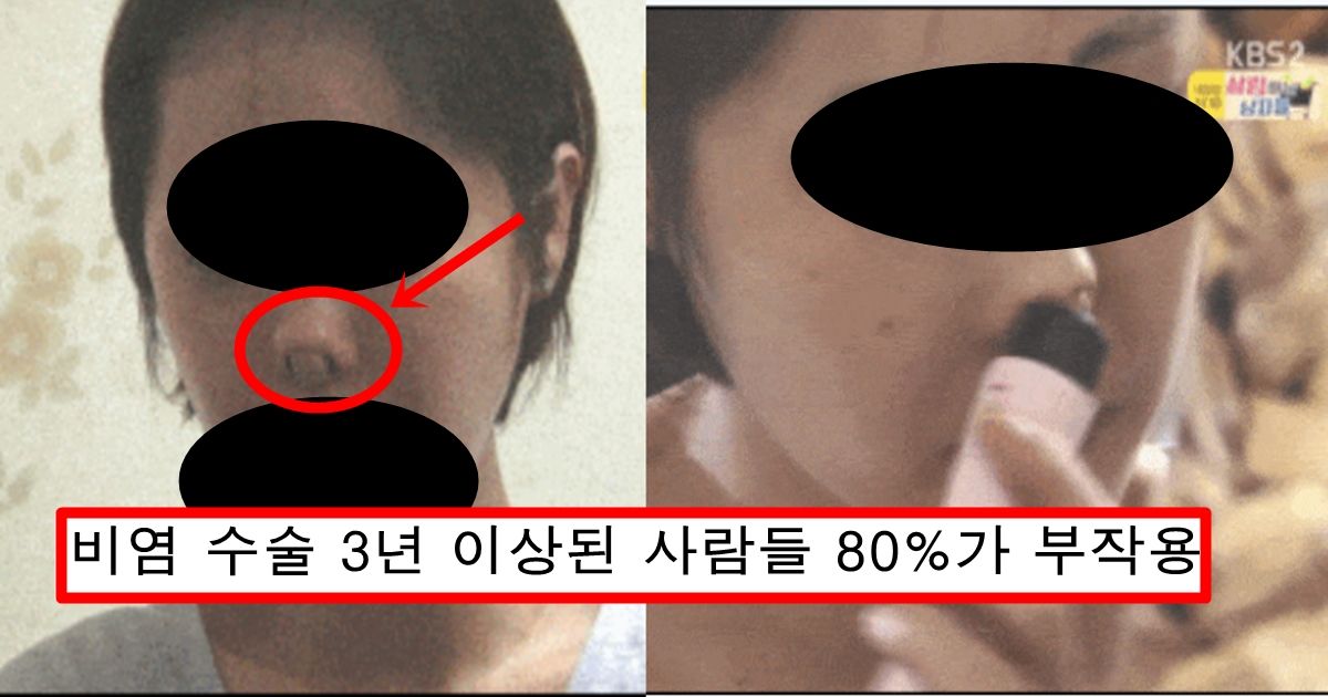 비염 수술 절대 하지말고 만약 한 사람은 3년안에 다 큰일난 이유 ㄷㄷ