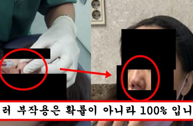 현재 성형외과 원장 양심선언으로 난리 난 필러 한 번이라도 맞은 사람은 10년 뒤에 다 ㅈ된 이유