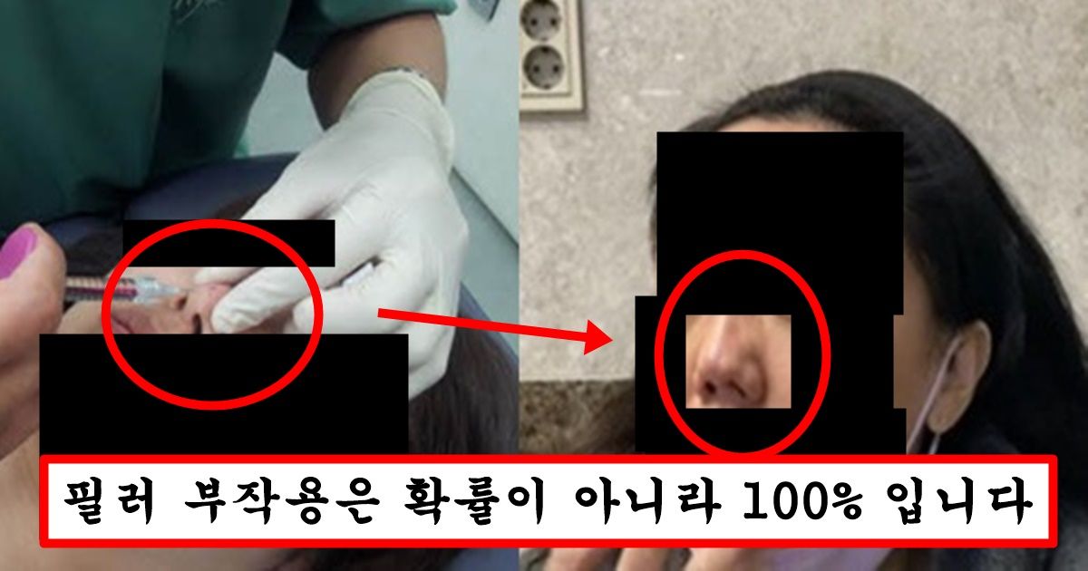 현재 성형외과 원장 양심선언으로 난리 난 필러 한 번이라도 맞은 사람은 10년 뒤에 다 ㅈ된 이유