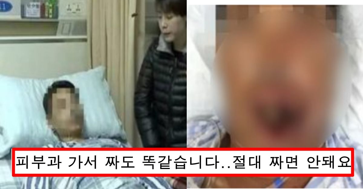 “여드름 절대 짜지 마세요”요즘 한국에서 여드름 짰다가 사망,피부괴사하는 사건 엄청나게 발생중