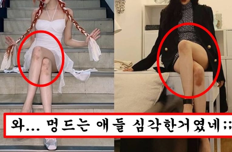 분명 부딪힌적도 없는데 여자 몸에 멍이 생기는 소름돋는 이유