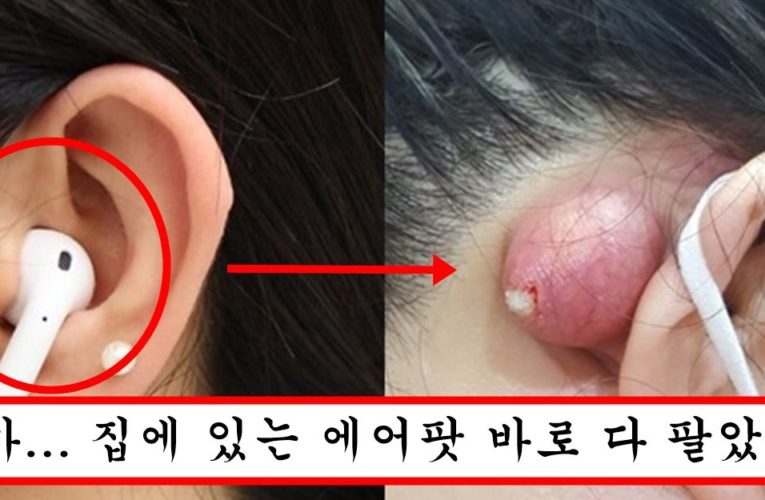 에어팟이나 버즈 쓰는 사람 지금 당장 병원 가서 검사해봐야 하는 이유