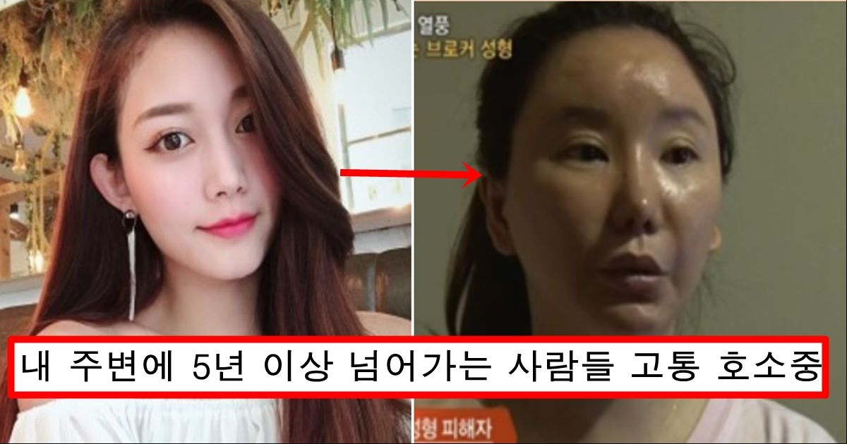 안면윤곽 수술 나온지 올해로 14년째 실시간 인스타에 올라오고 있는 안면윤곽러들 심각한 상황