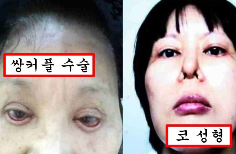 요즘 성형외과 의사들이 성형 소송 무죄 뜨자 일부러 하고 있다는 여성 타겟 얼굴 망치기 수법