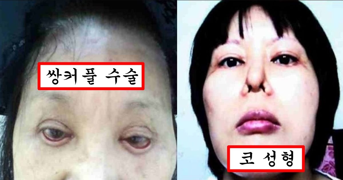 요즘 성형외과 의사들이 성형 소송 무죄 뜨자 일부러 하고 있다는 여성 타겟 얼굴 망치기 수법