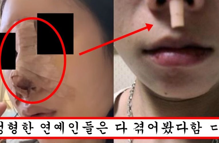 현재 코 과하게 올린 연예인들에게 공통적으로 일어나고 있는 충격적인 부작용 수준