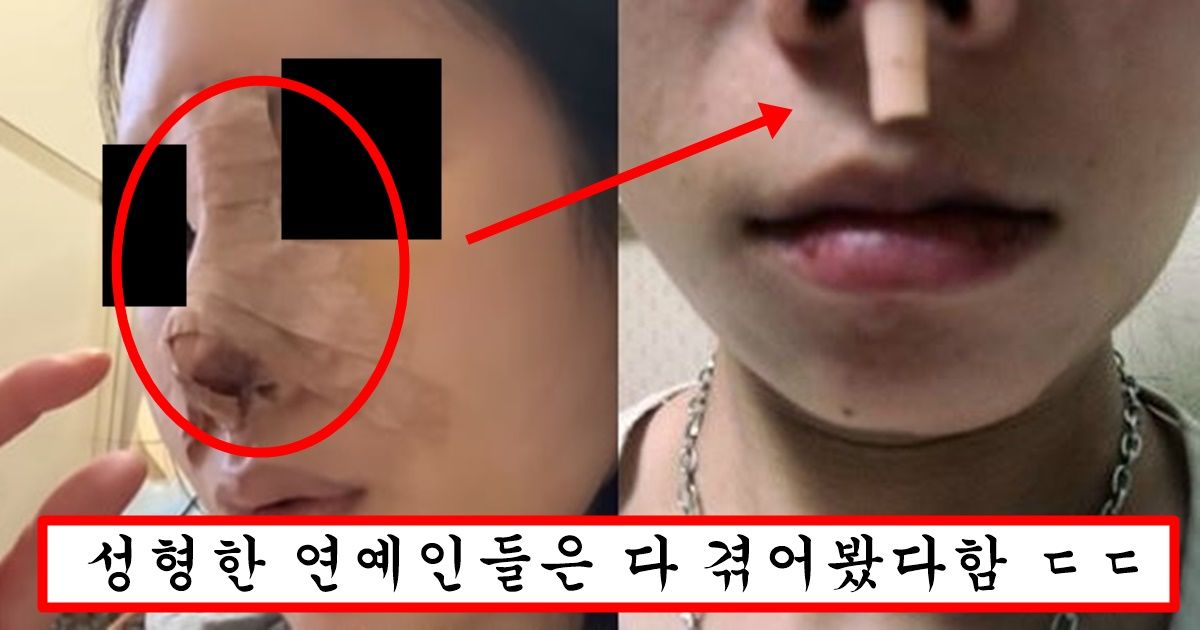 현재 코 과하게 올린 연예인들에게 공통적으로 일어나고 있는 충격적인 부작용 수준