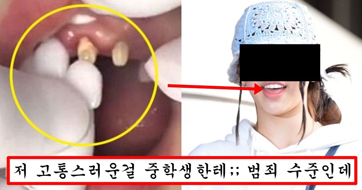 중학생 2명을 이가 누렇다는 이유로 하기 싫다는 라미네이트 강제로 시켜버린 소속사