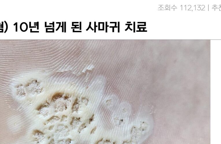 극혐) 10년 넘게 된 사마귀 치료 중인데 올려봄